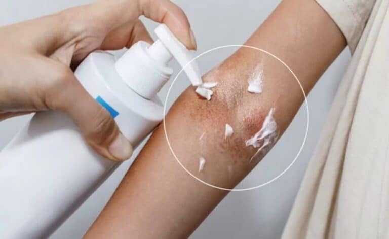 Imagem de uma dermatite atópica